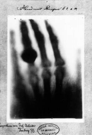 120 éves az első röntgenkép