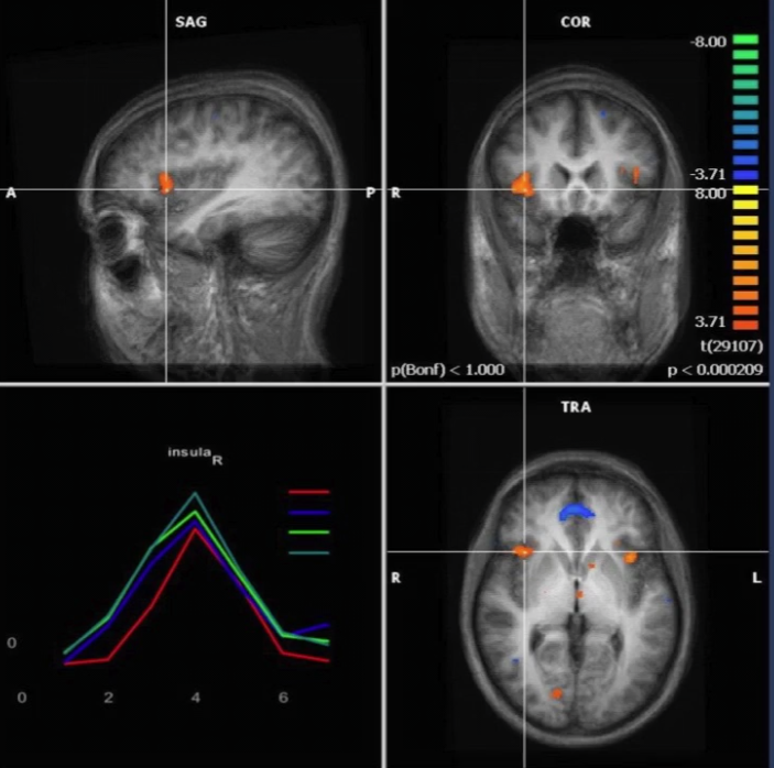 Funkcionális MRI az agykutatásban: mítosz és valóság