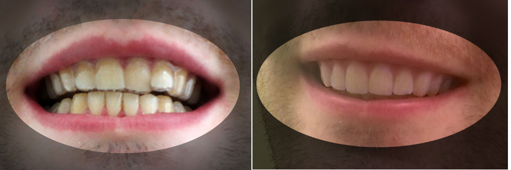 Egy amerikai egyetemista fityiszt mutatott a fogszabályzómaffiának
