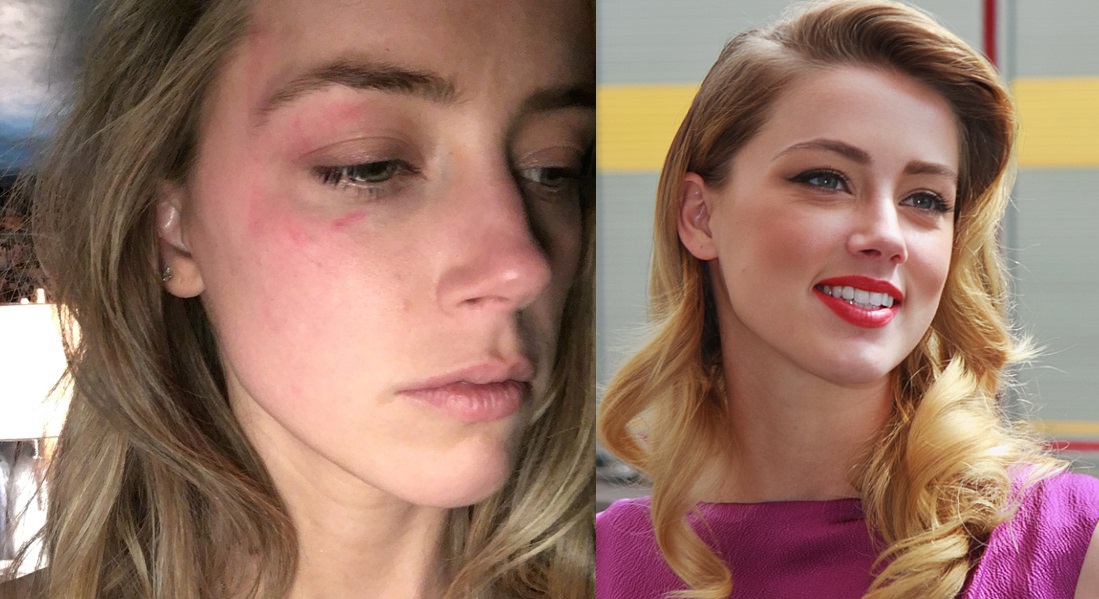 Amber Heard szerint az exférje, Johnny Depp bántalmazta őt