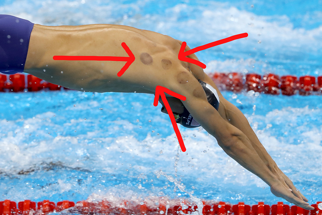 Phelps piros körös doppingja: a köpölyözés