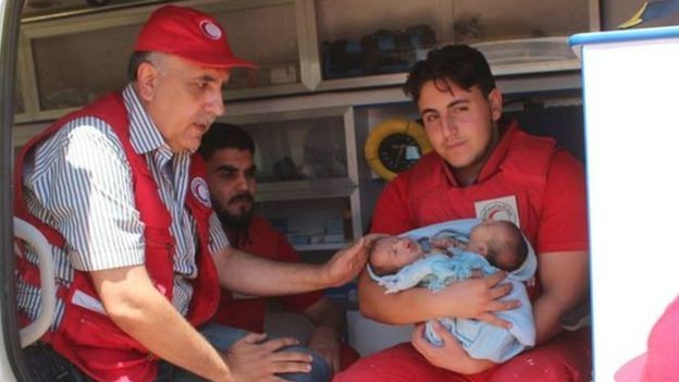 Meghaltak a Szíriában született sziámi ikrek