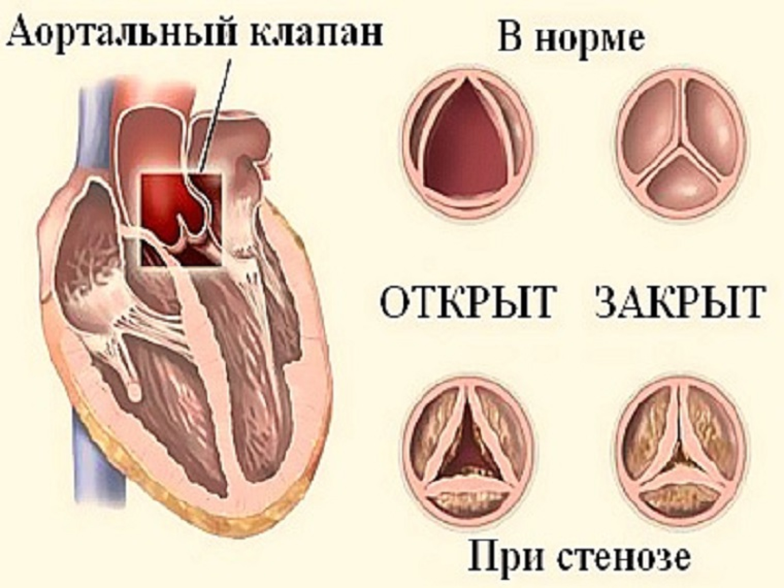 Приобретенный порок клапана сердца