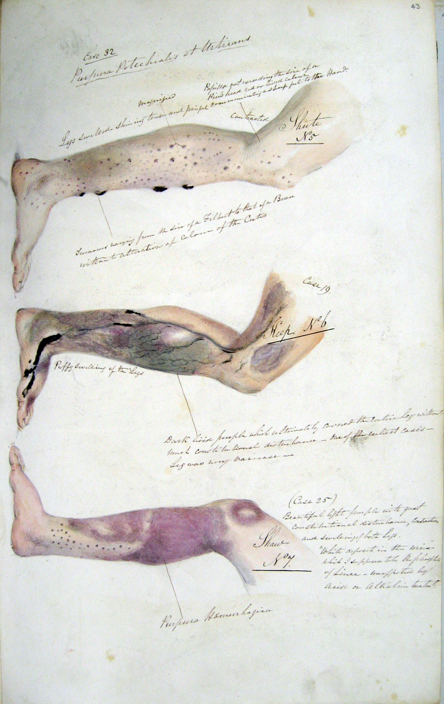 Henry Walsh Mahon ausztrál hajóorvos 1841-es tanulmánya a skorbut tüneteiről