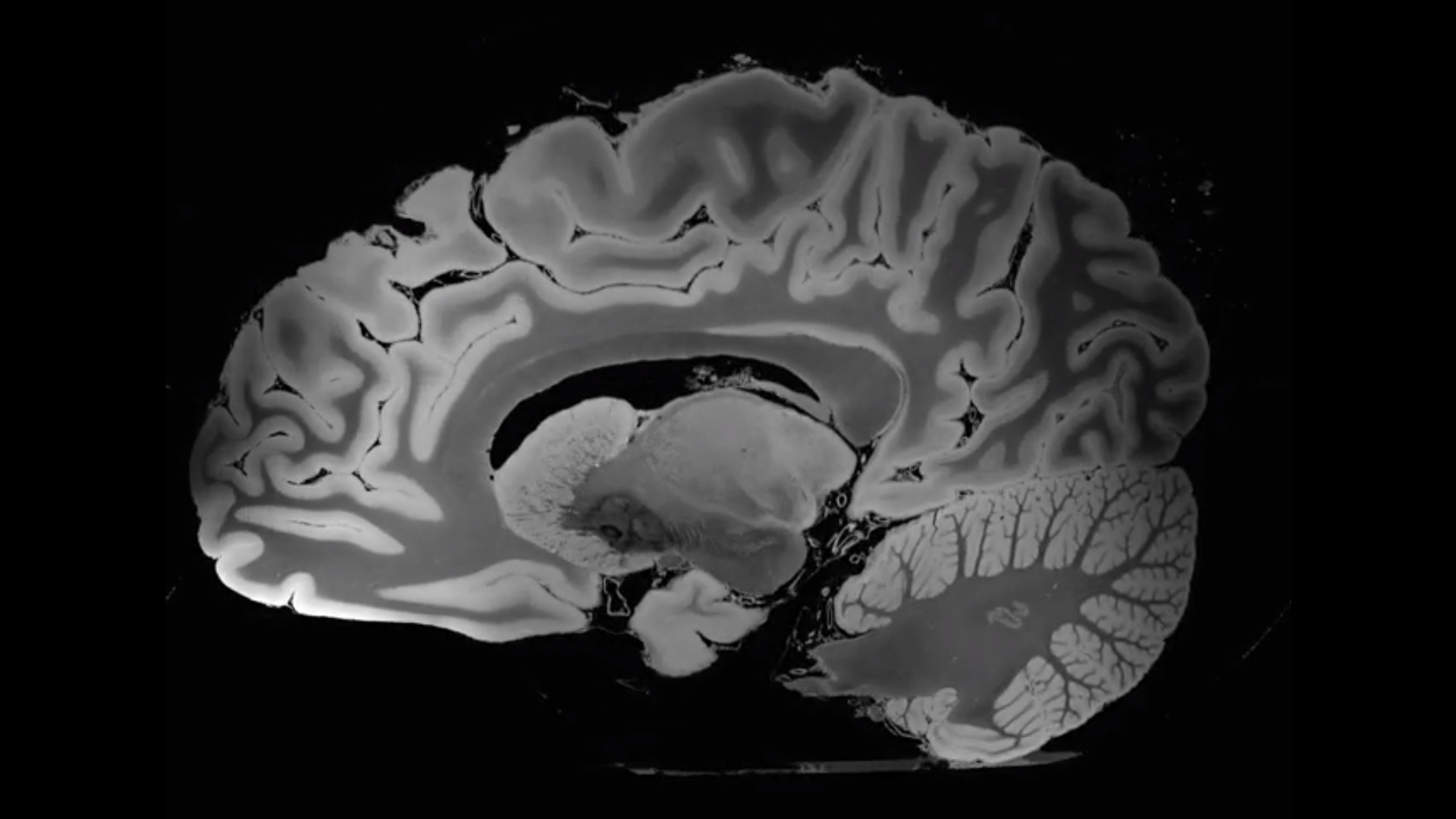 100 órán át készült ez a minden eddiginél részletesebb MRI-felvétel az emberi agyról
