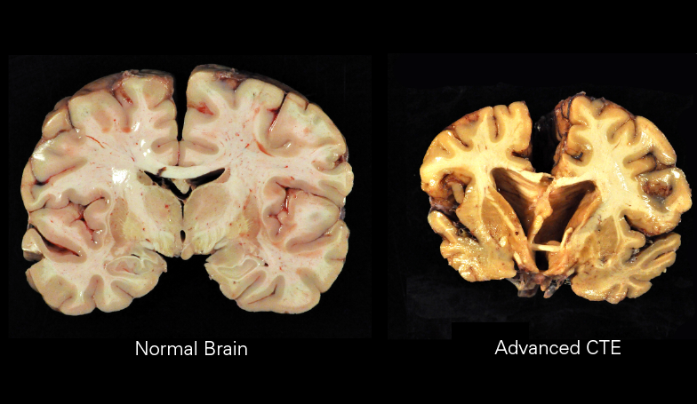 Az egészséges és a krónikus traumatikus enkefalopátiával diagnosztizált emberi agy képe