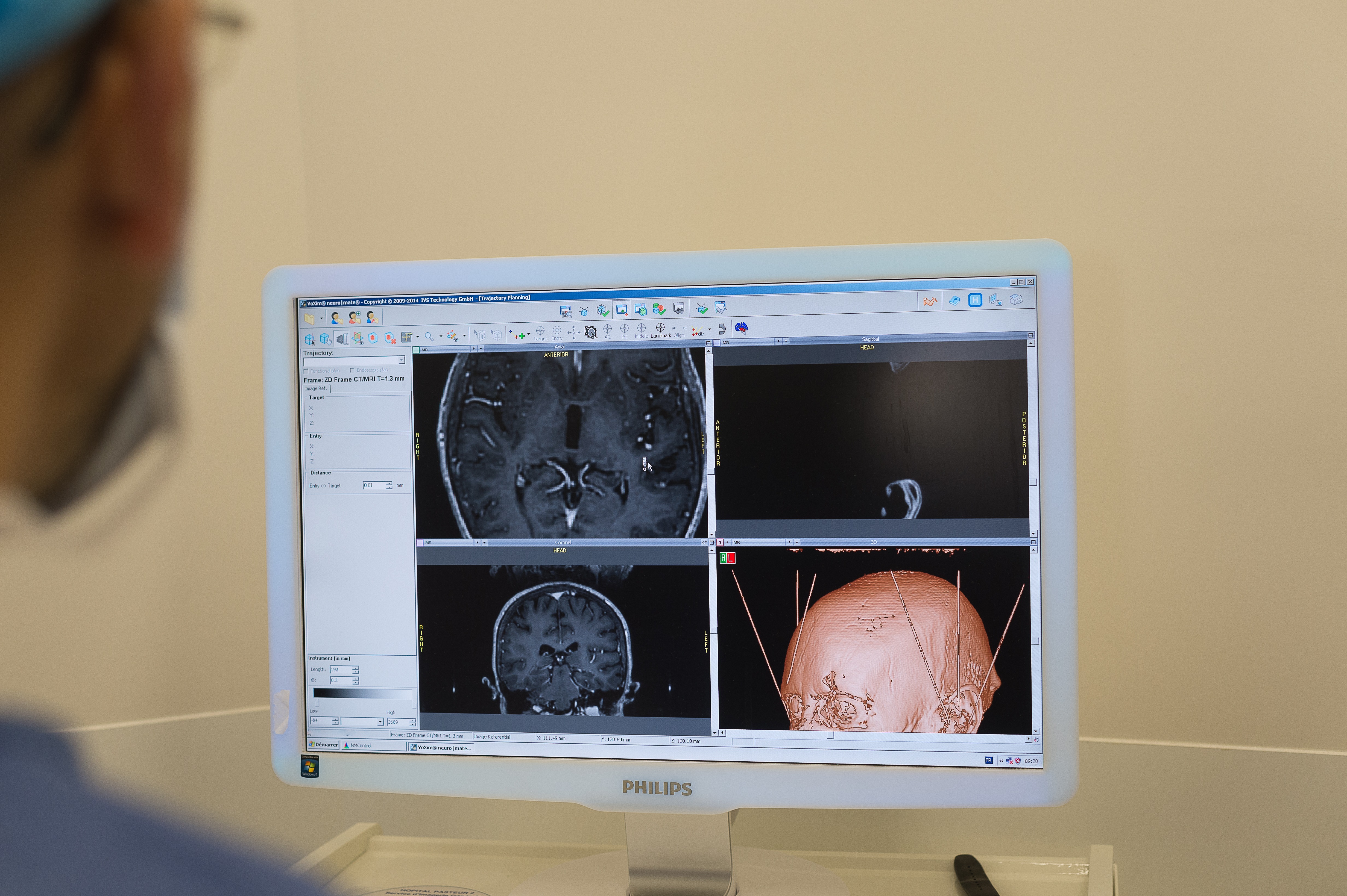 Mély agyi stimulációt végeznek egy Parkinson-kóros betegen egy nizzai kórházban