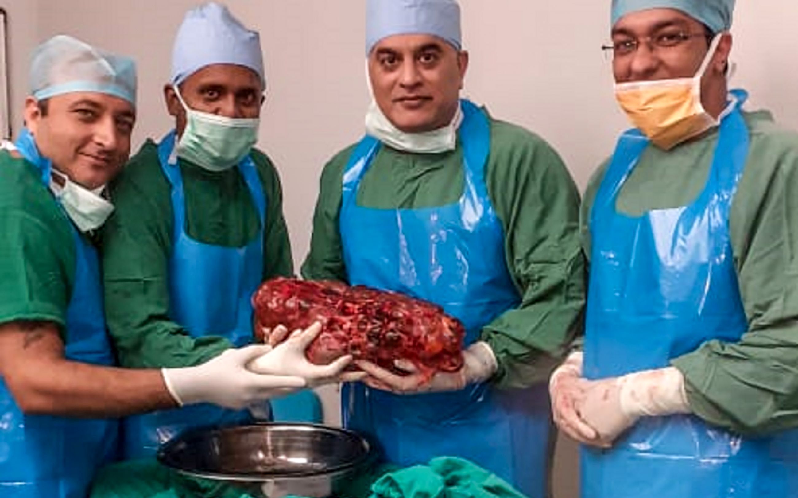 7,4 kilós vesét távolítottak el páciensükből indiai sebészek