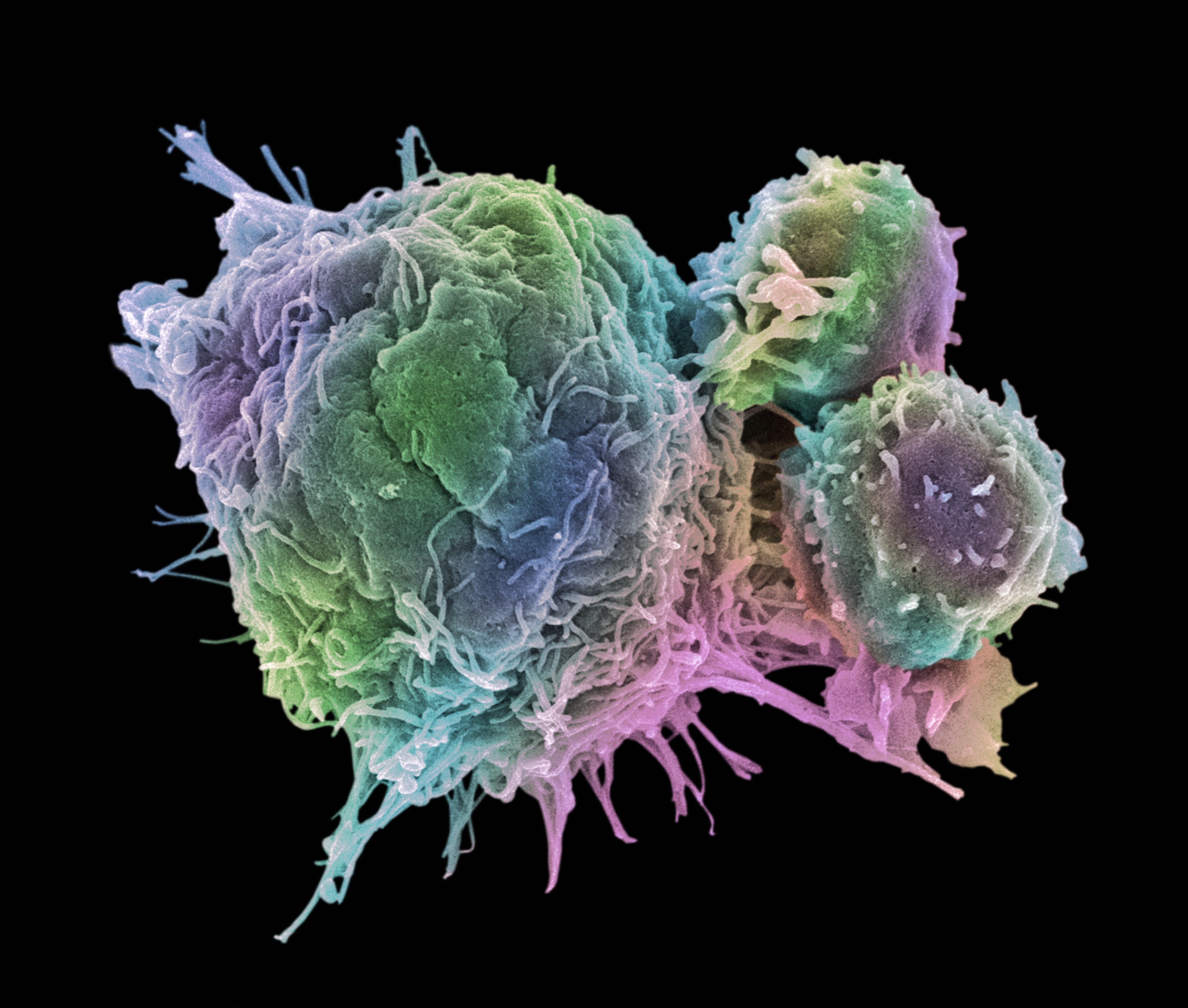 Megvan a mechanizmus, amellyel a felturbózott immunsejtek legyőzhetik a rákot