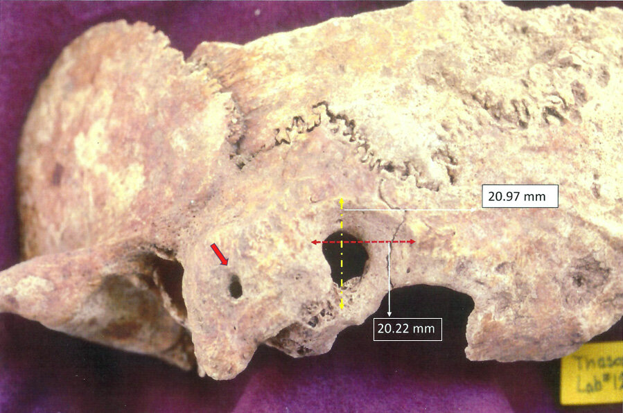 Bonyolult agyműtét nyomait fedezték fel egy kora középkori görög leleten