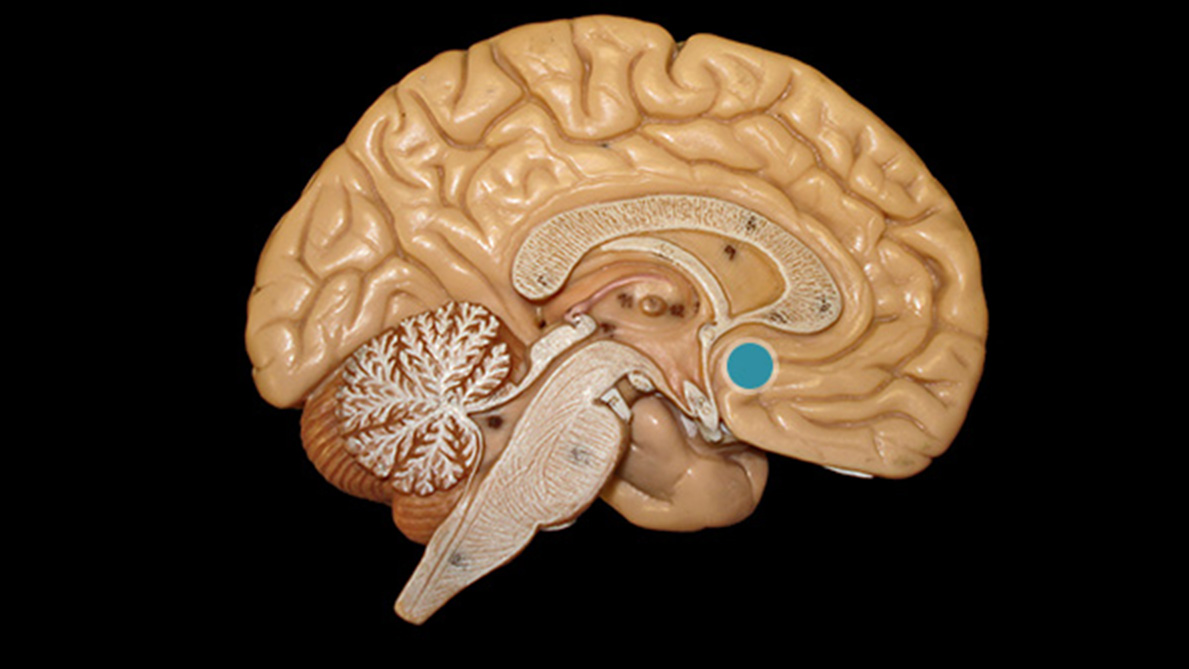 Magyar kutatók a demencia kialakulásában érintett idegsejteket különítettek el az agyban