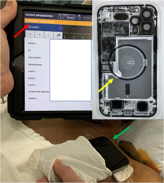Az implantátumhoz tartozó alkalmazás eszközbeállításainál látszik, hogy az ágyon, a páciens mellkasához közel fekvő iPhone 12 (zöld nyíl), pontosabban az abban található kör alakú mágnes (sárga nyíl) felfüggesztette a beültethető defibrillátor működését (piros nyíl).