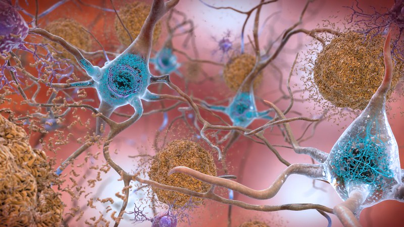 Ígéretes molekulát találtak az Alzheimer-kór megelőzésére