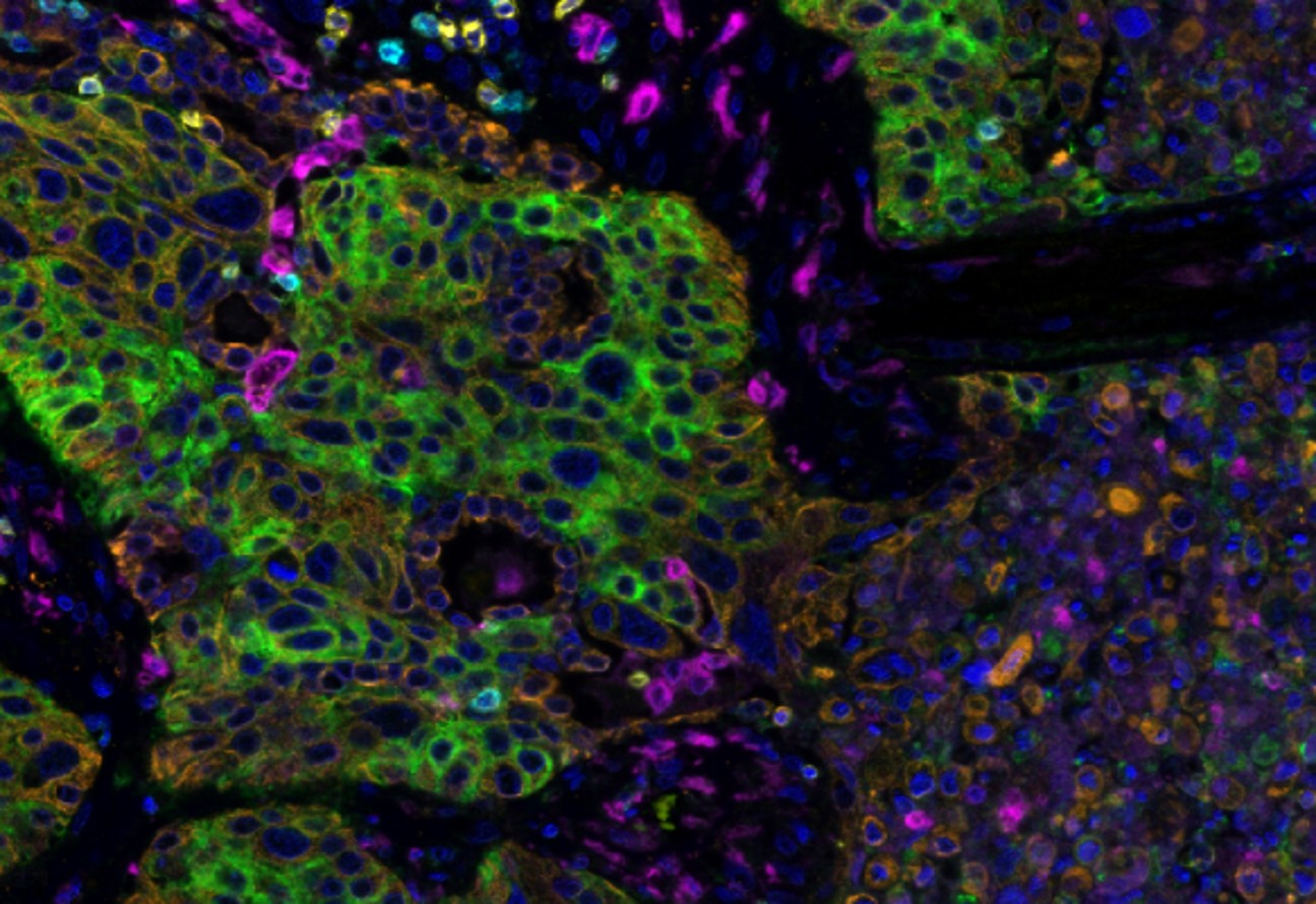 Immunofluoreszcens felvétel egy rákos sejtről