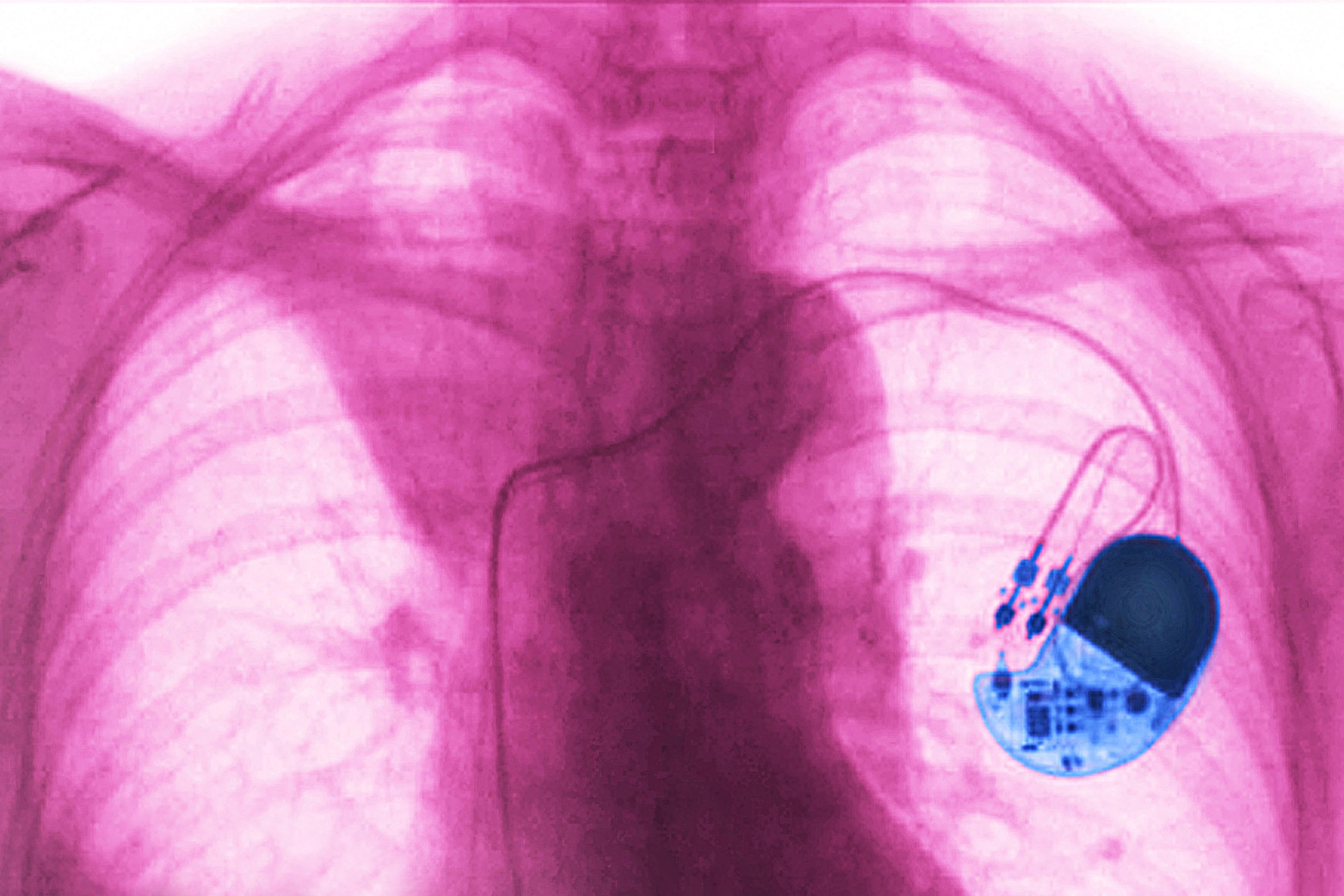 A felszívódó pacemaker lehet az ideiglenes szívritmus szabályozás csodafegyvere