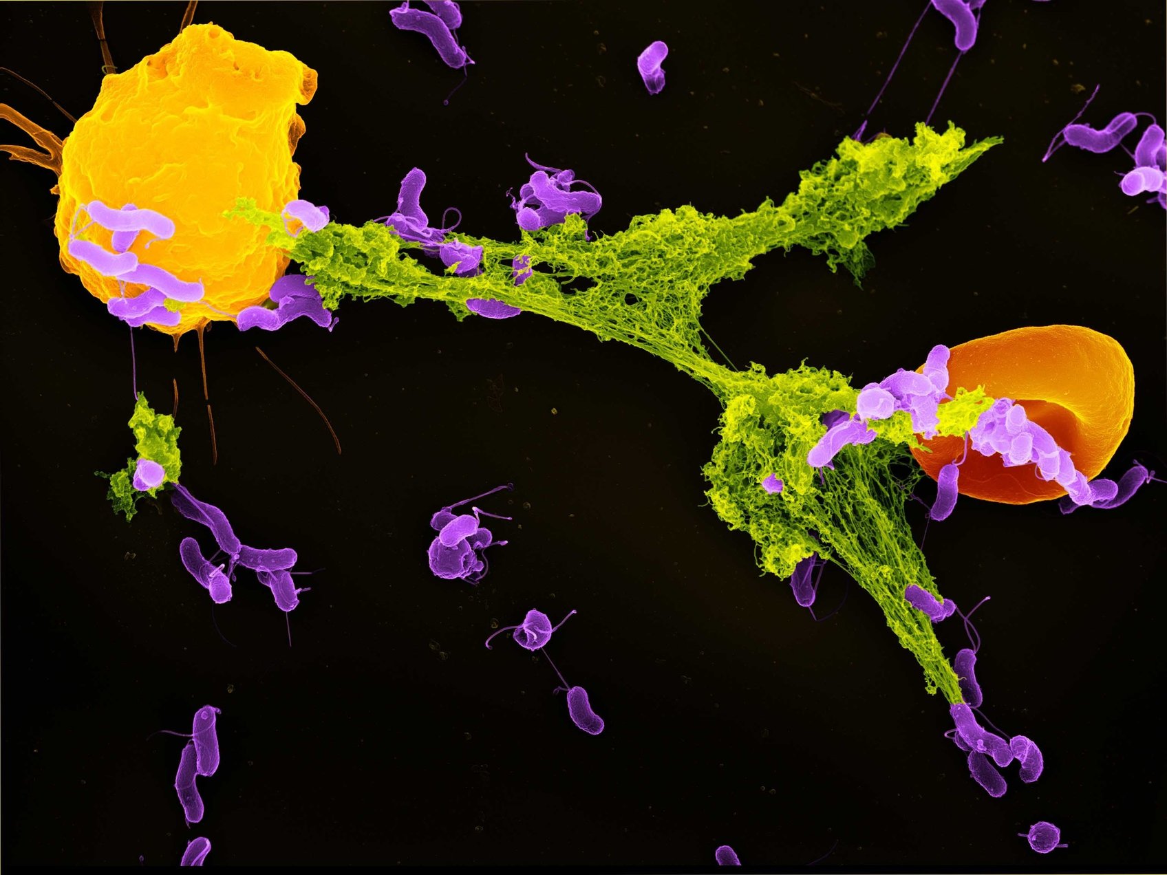 A sárga neutrofil granulociták által kibocsátott zöld NET, ahogy behálózza a lila baktériumat