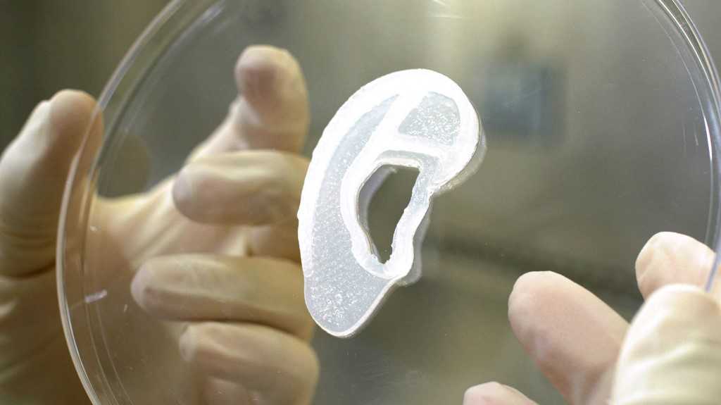 A saját sejtjeiből készült 3D-nyomtatott fület kapott egy nő