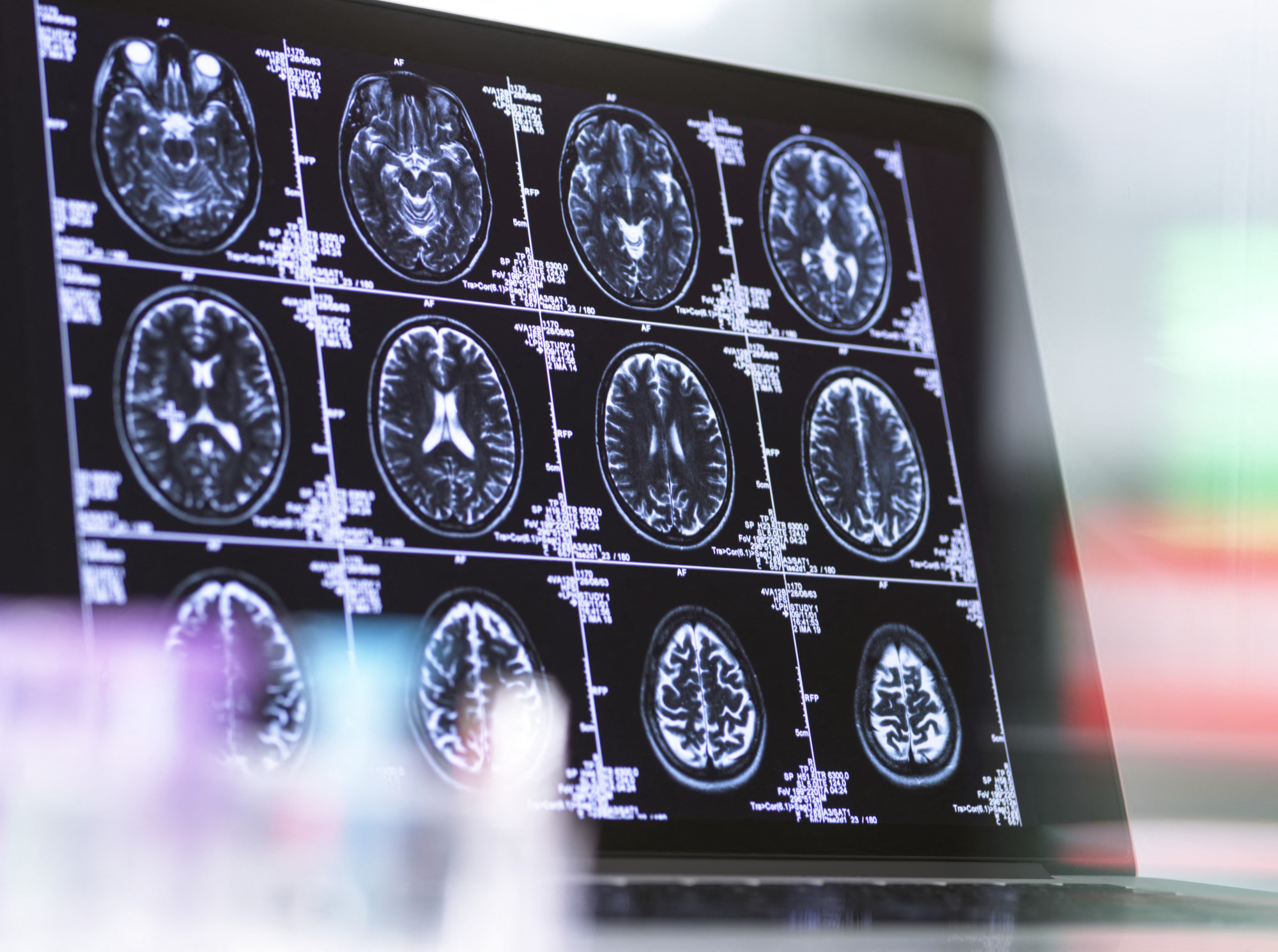 MRI-felvétel egy ember agyáról