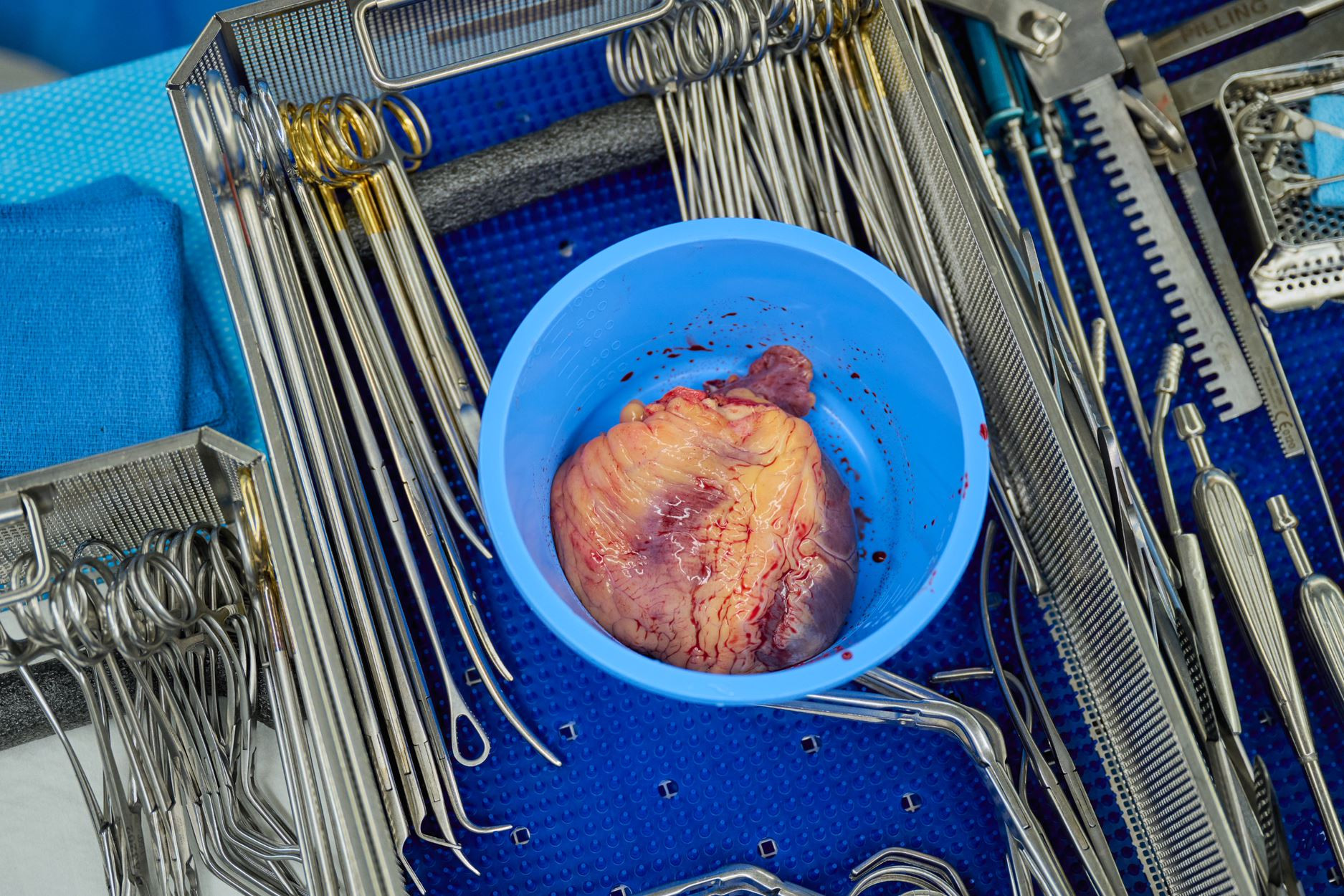 Újabb transzplantációs mérföldkő: disznószívet ültettek két agyhalott ember testébe