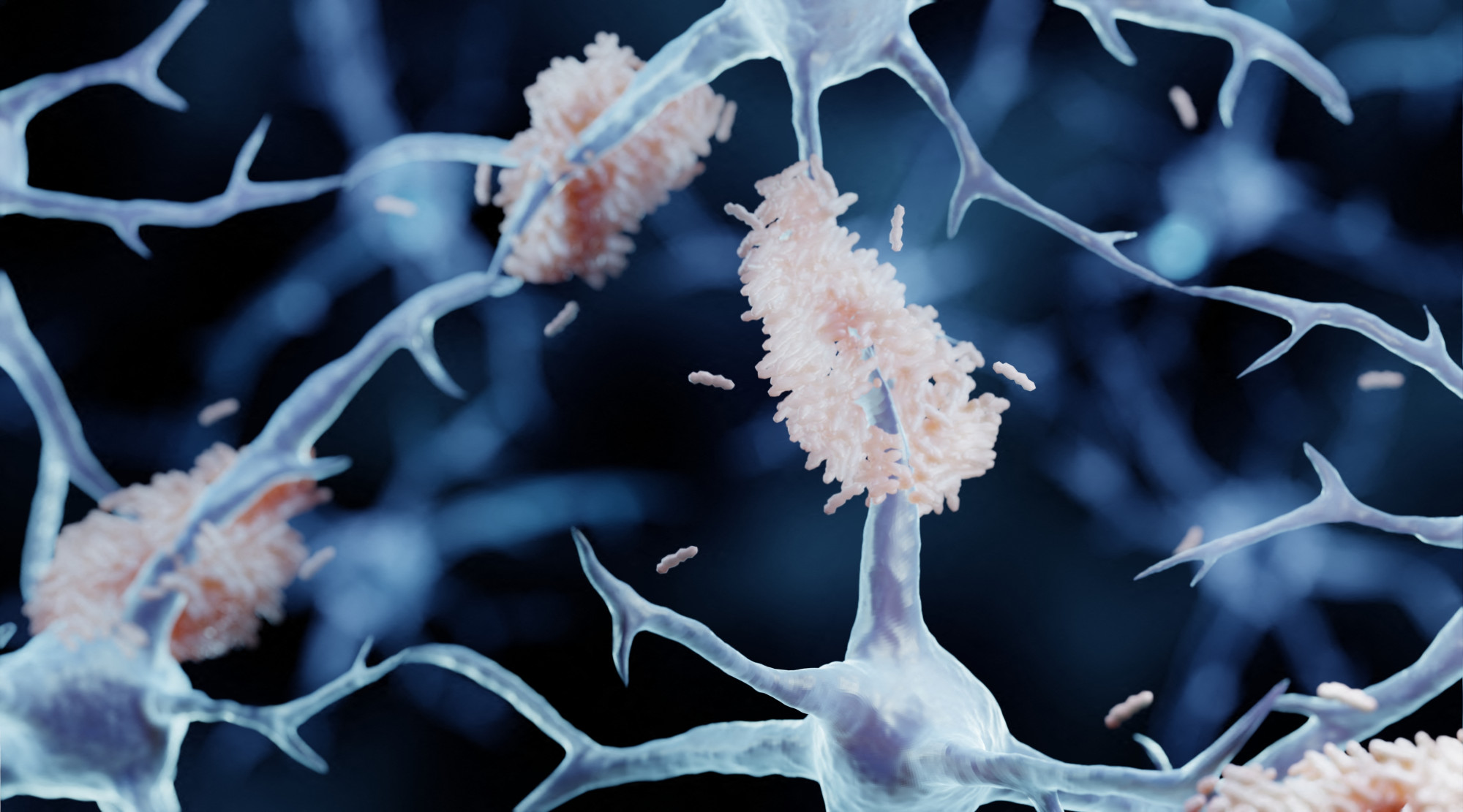 Az idegsejtek közé lerakódott amiloid plakkok