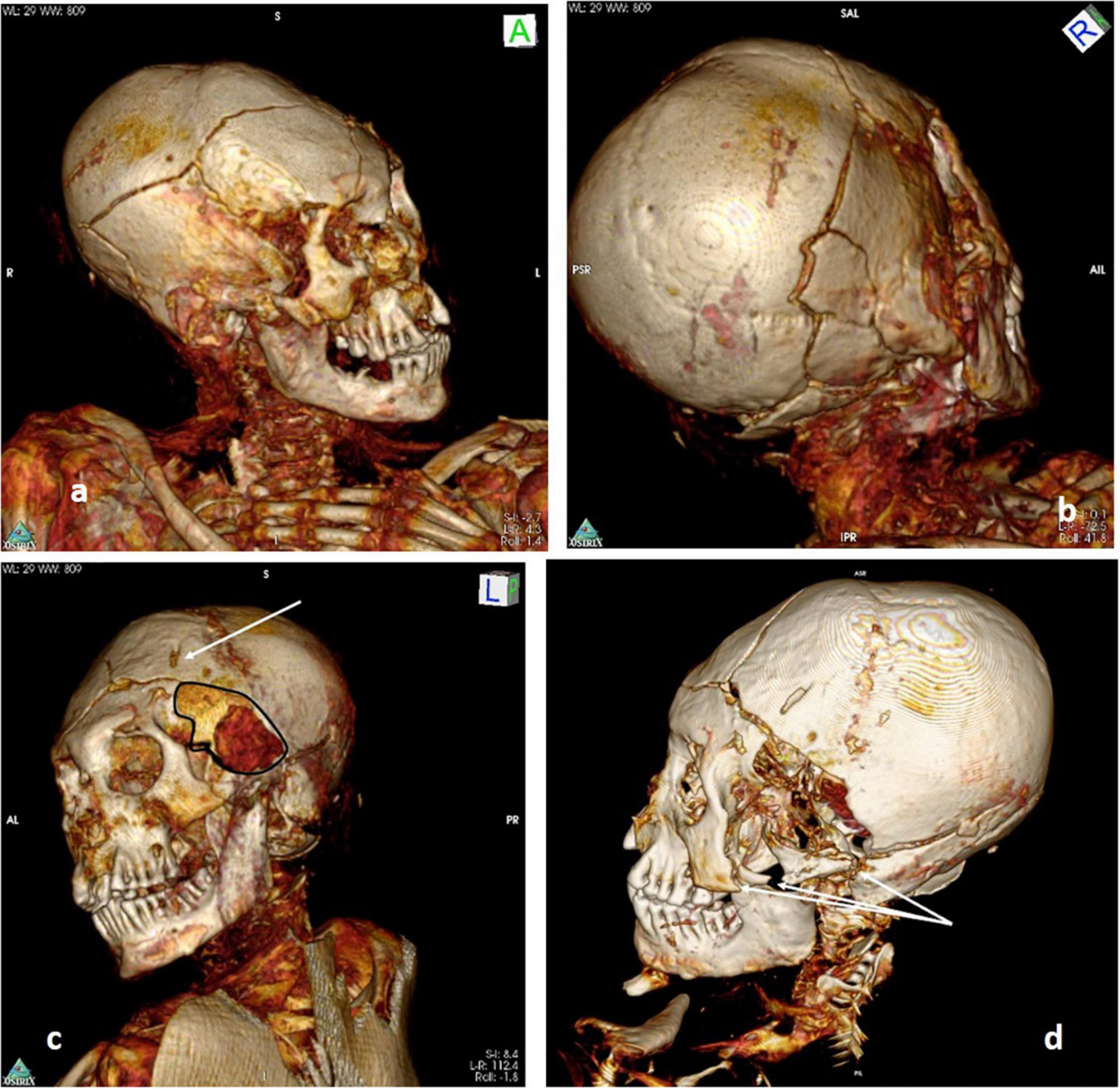 A delémont-i férfi múmiáról készült 3D-s CT-felvétel