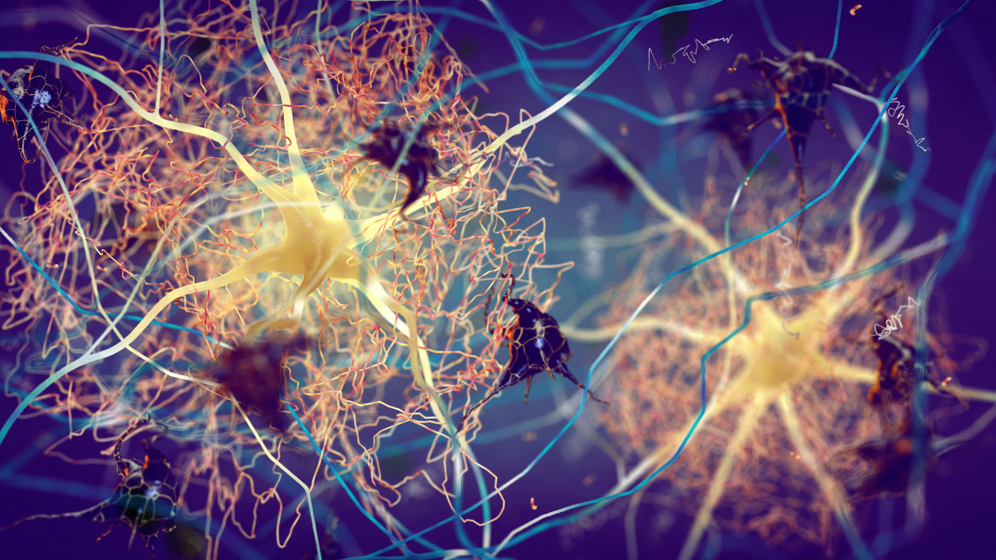Egy Alzheimer-kóros beteg agyának idegsejtjei között lerakódott béta-amiloid plakkok