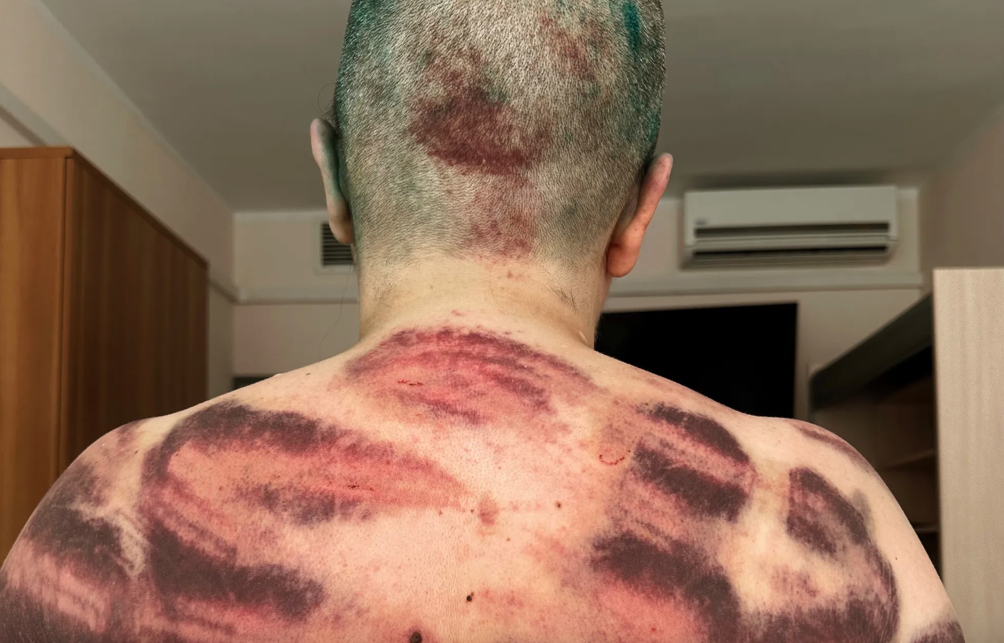 Így néz ki Jelena Milasina háta, miután kegyetlenül összeverték Csecsenföldön