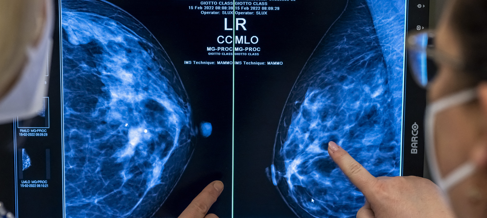 A mesterséges intelligencia már mellrákot is diagnosztizál