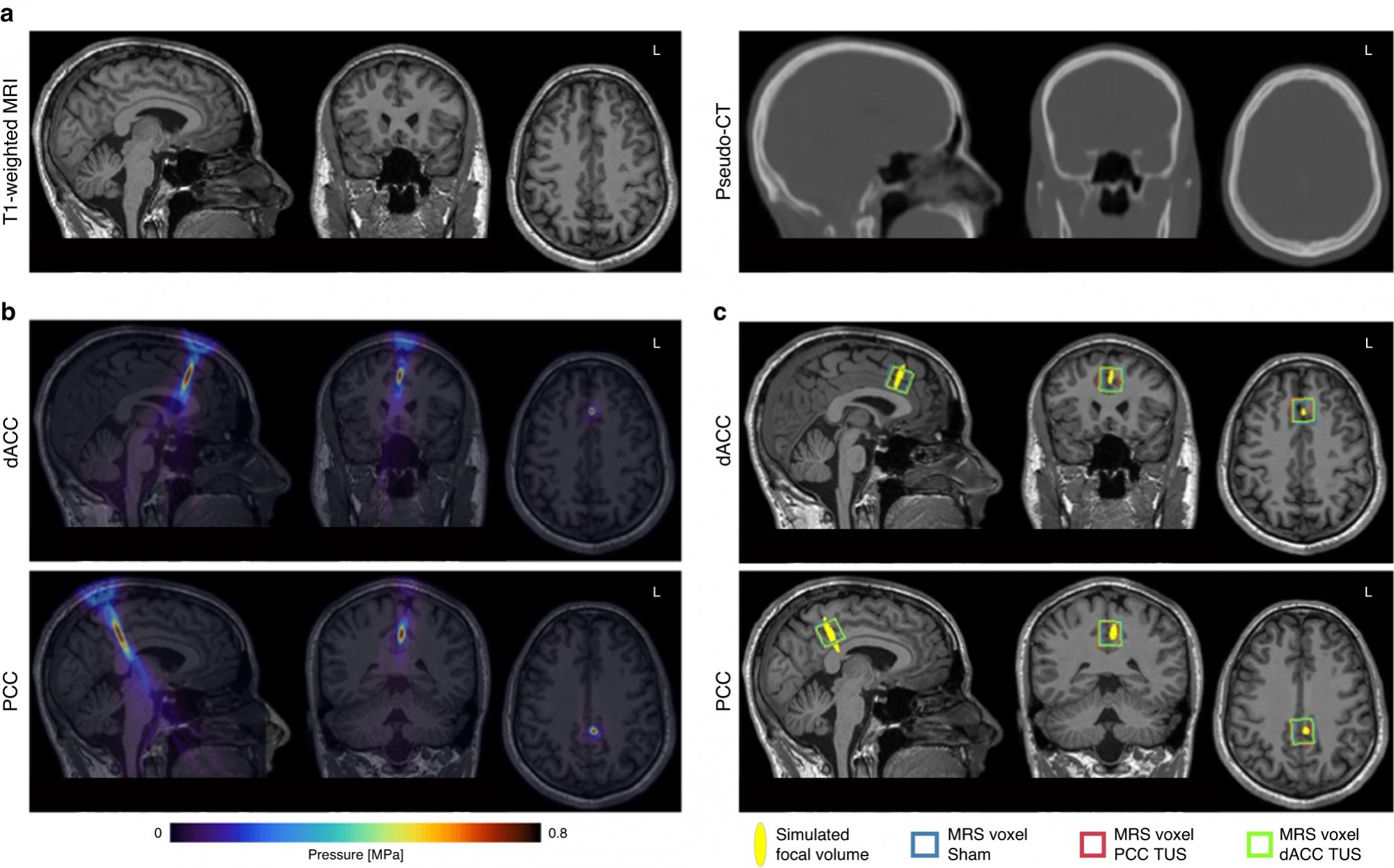 Az agyi aktivitás változása még egy órával a kezelés után is érzékelhető maradt. a) A T1-súlyozott MRI-ből (balra) származtatott pszeudo-CT (jobbra), amit a koponya akusztikus tulajdonságainak becslésére használtak. b) A T1-súlyozott MRI-re illesztett ultrahangnyomás-mező a dorzális elülső cinguláris kéreg (dACC) és a hátsó cinguláris kéreg (PCC) célzott elérését mutatja. c) A transzkraniális ultrahangstimulációs (TUS) fókusznyomás-térfogat