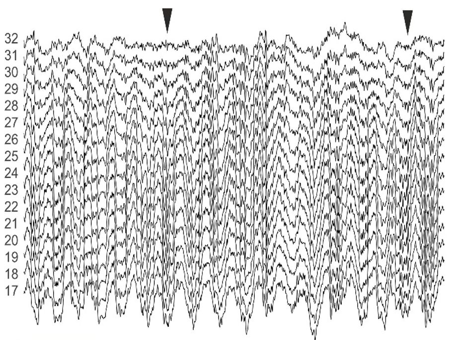 A théta és thétába ágyazott gamma oszcillációk a hippokampusz CA1 régiójából többcsatornás elektróda felvételén
