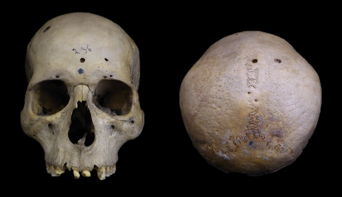 Egy kb. 4500 éves koponya vizsgálata alapján már az ókori Egyiptomban megpróbálhatták kezelni a rákot