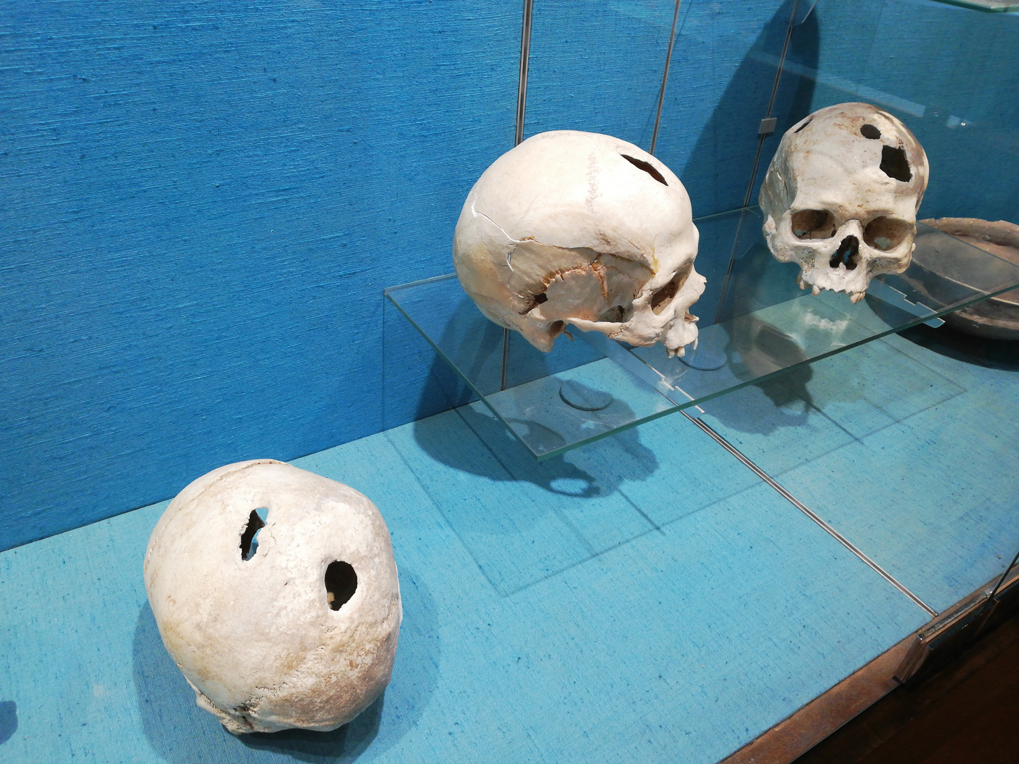 A koponyalékelés bevett sebészeti módszer volt a neolitikumban