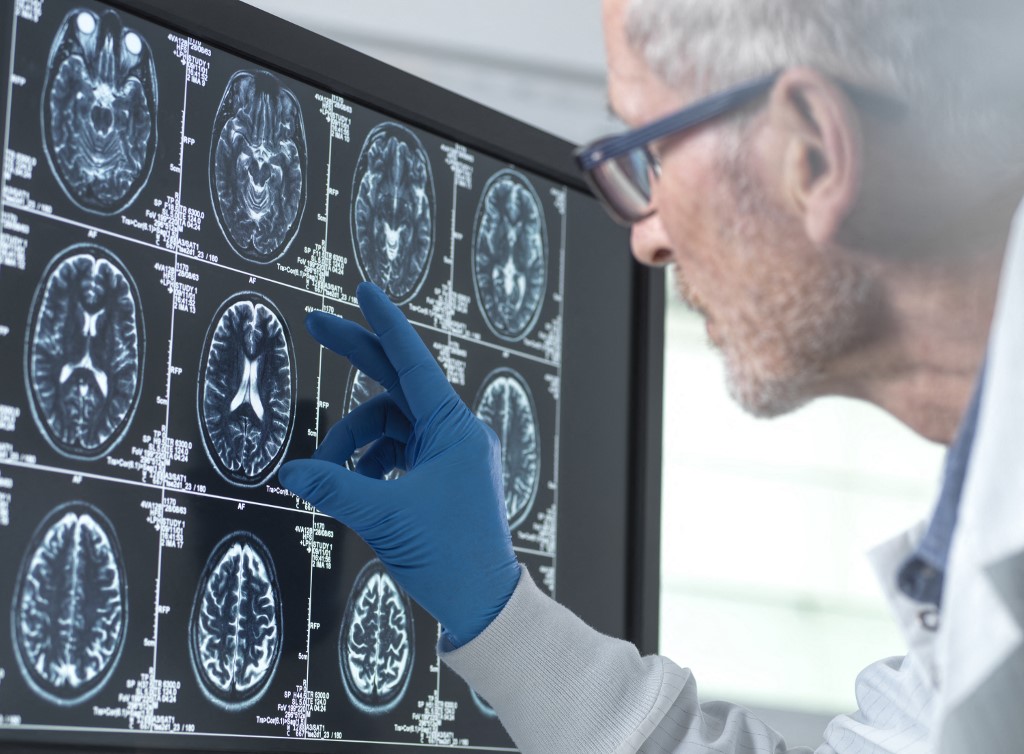 Az Alzheimer-tesztek többet és mást is megmutathatnak, nemcsak a kór jelenlétét