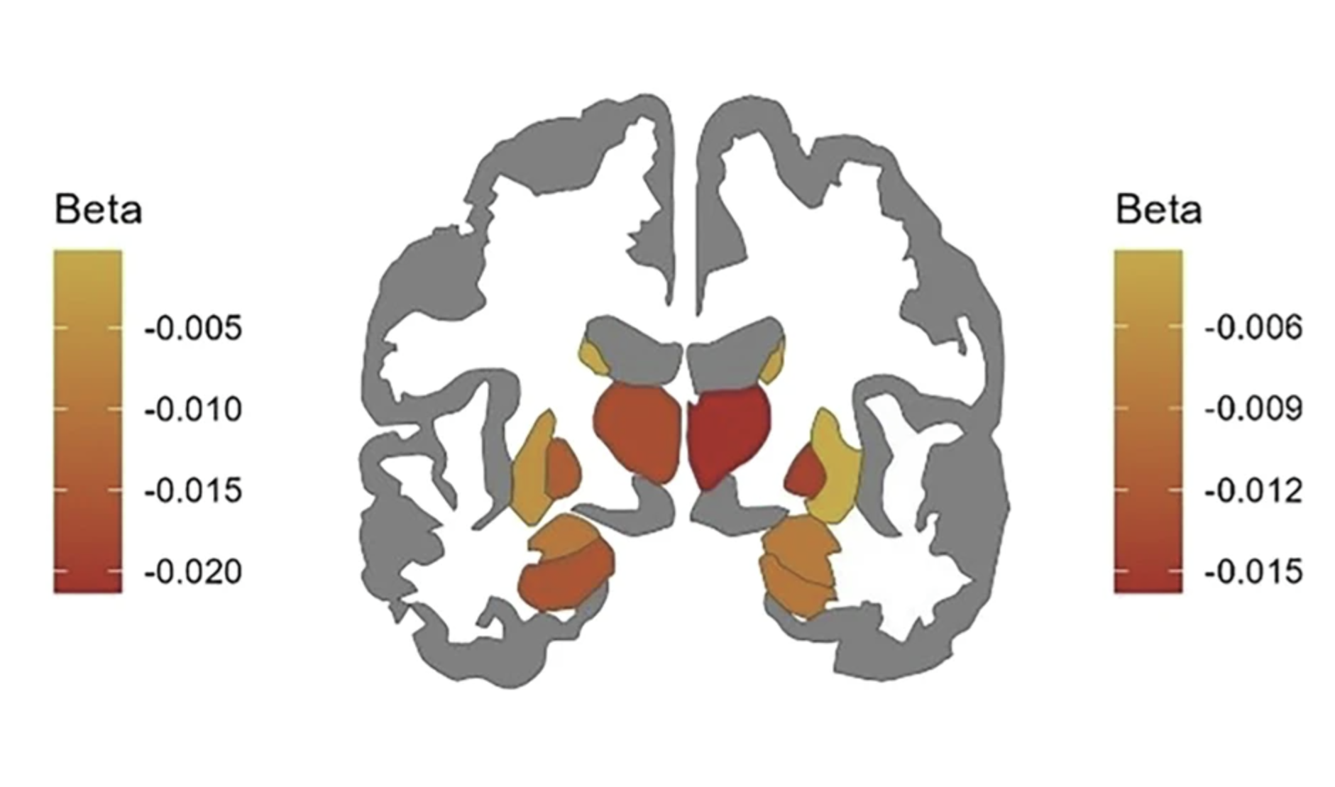 Összefüggés lehet a depresszióra való hajlam és az agyi felépítés között