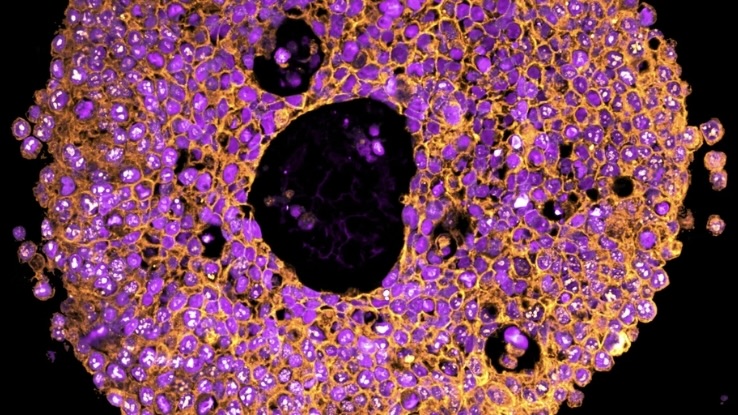 Mini méhlepényeket készítettek 3D-s bionyomtatóval, amik egy súlyos terhességi szövődmény hátterébe adhatnak betekintést