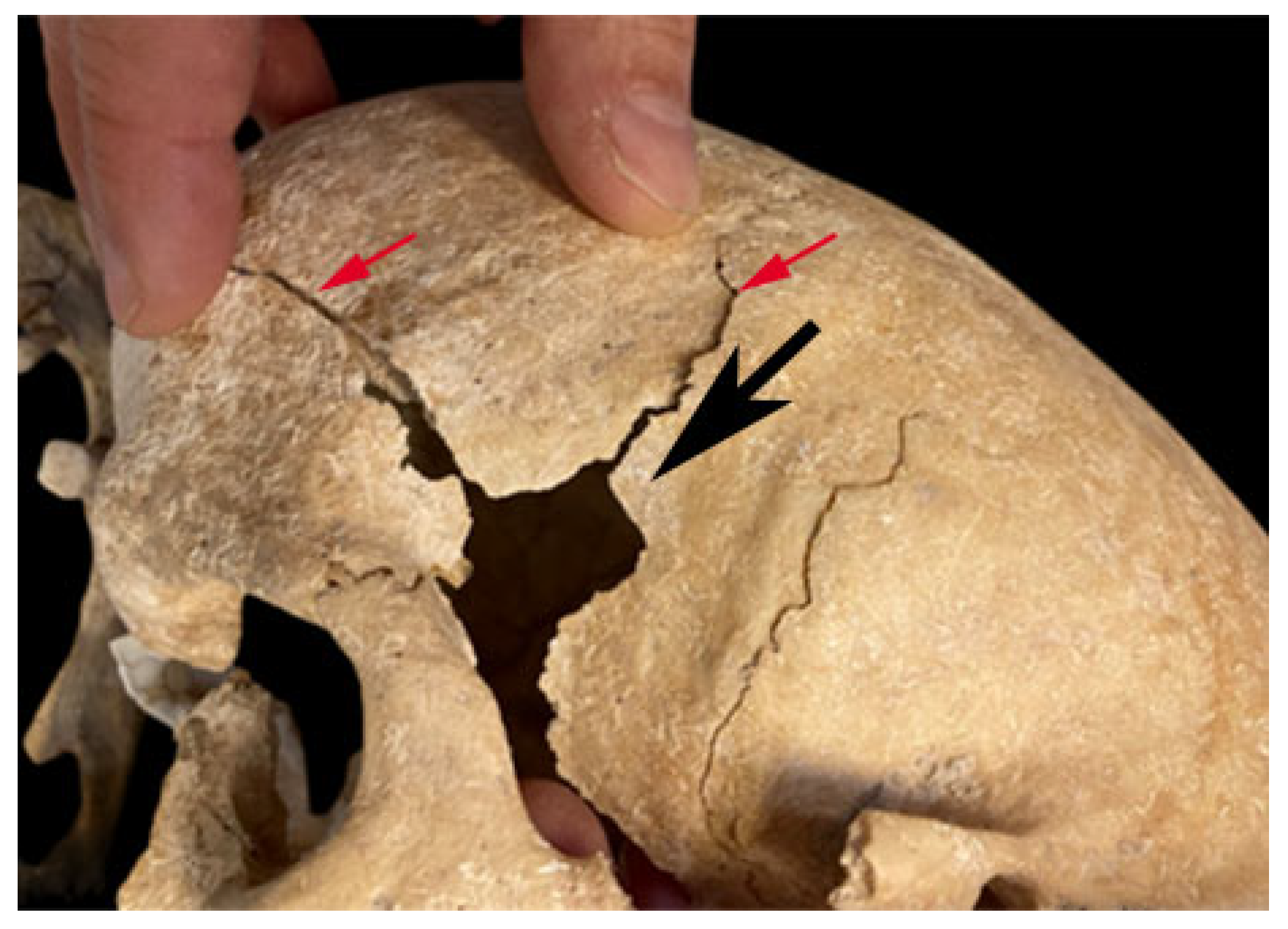 Halálos rendellenességgel élő középkori lovag koponyájára bukkantak Spanyolországban