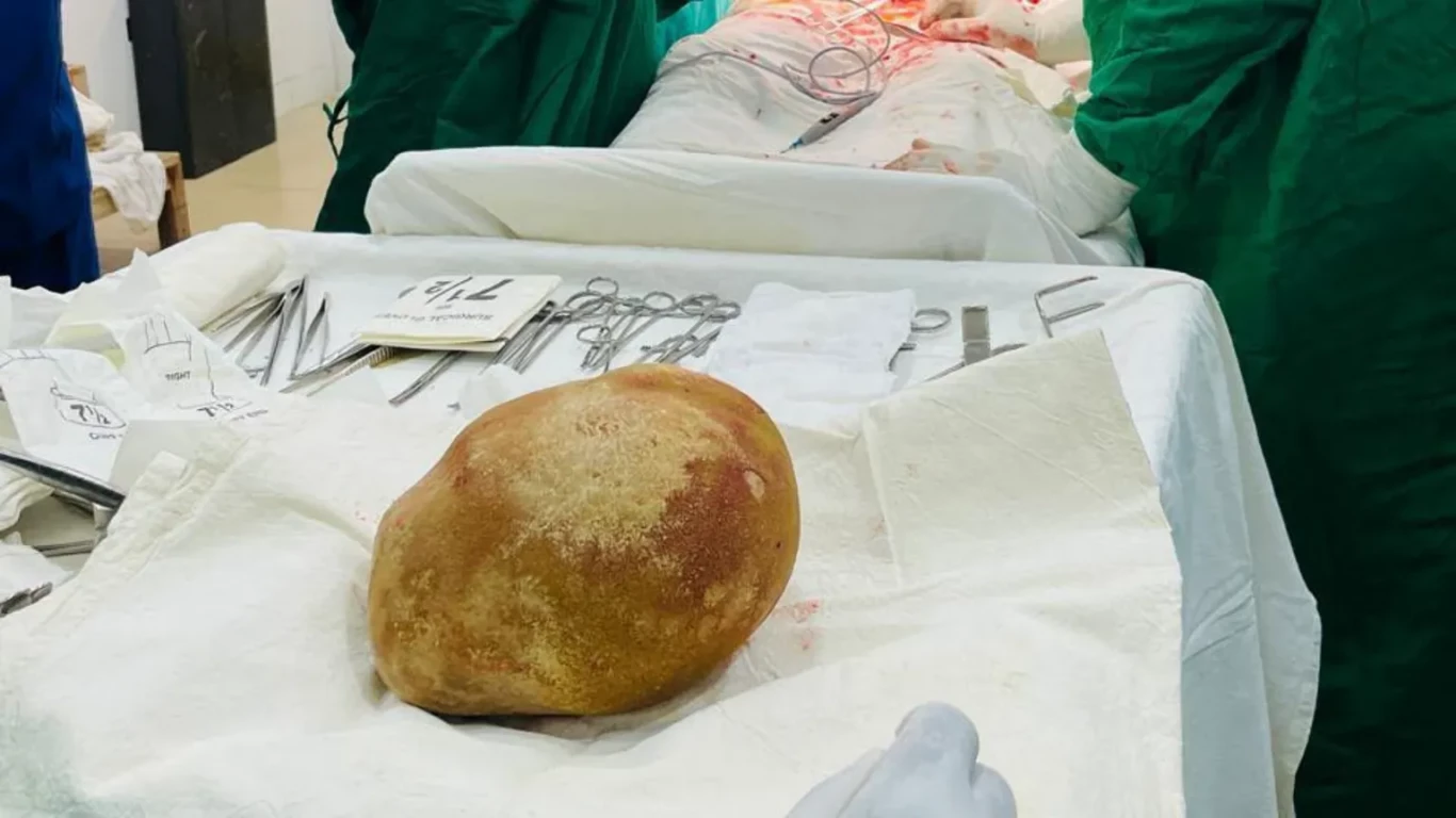 3,5 kilós követ szedtek ki egy férfi hólyagjából, aki nem vette észre, hogy kifejlett csecsemő súlyú, strucctojásnyi szikla akadályozza a vizelésben egy évtizede
